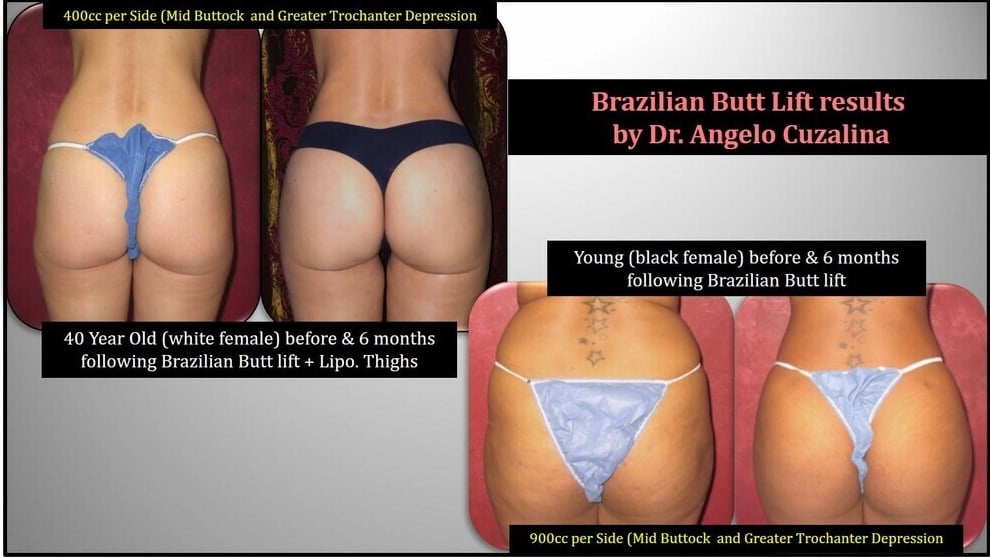 Brazilian Butt Lift vs Butt Implants: Which Is Best?