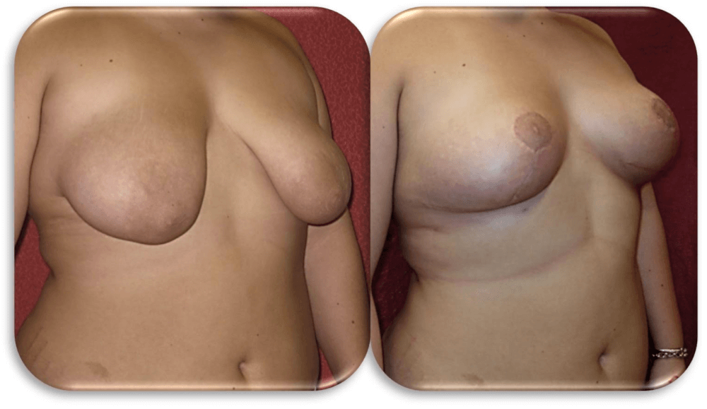 before and after breast lift